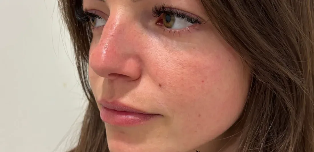 Visage de trois-quarts avant et après injection d'acide hyaluronique aux lèvres
